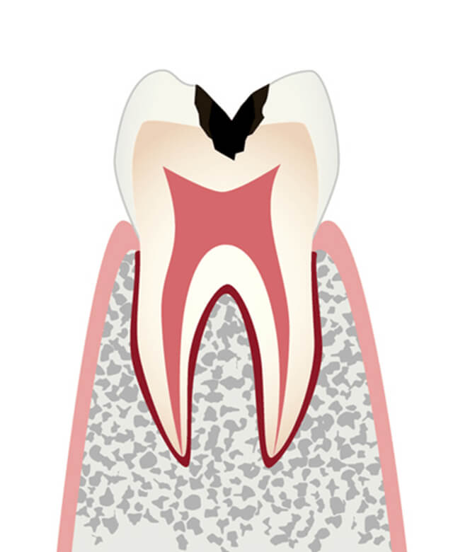 象牙質＝エナメル質のすぐ下にあり神経を守っている組織のむし歯