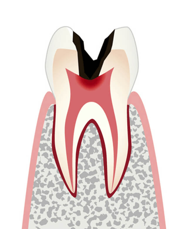 歯髄＝歯の神経まで達したむし歯