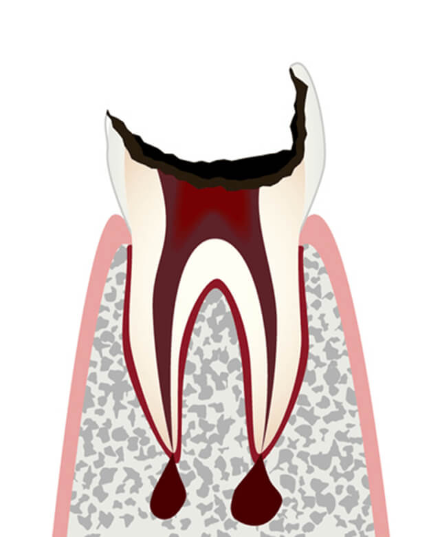 むし歯がかなり進行し歯の根っこだけが残った状態