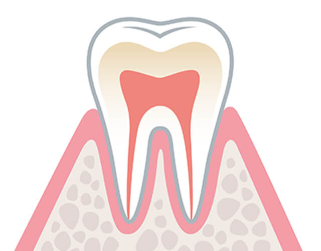歯肉炎のイラスト