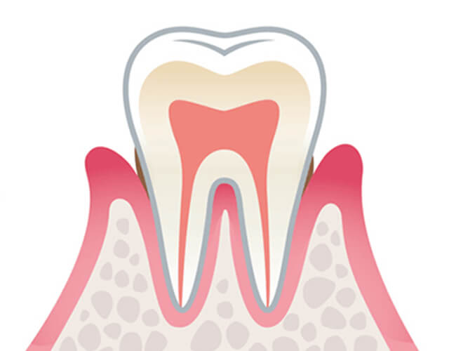 軽度から中等度の歯周炎のイラスト