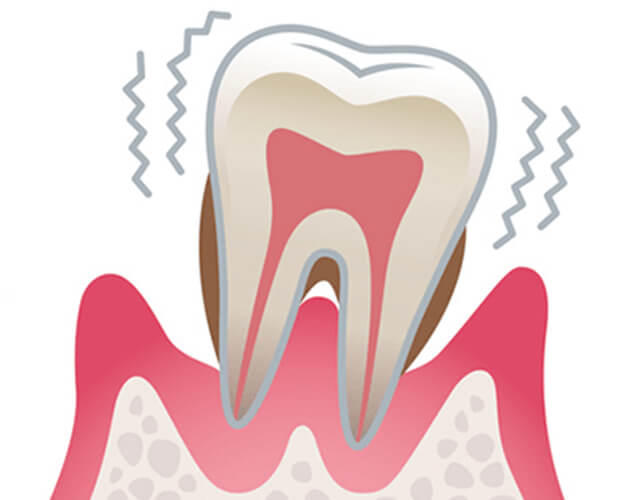 重度の歯周炎のイラスト