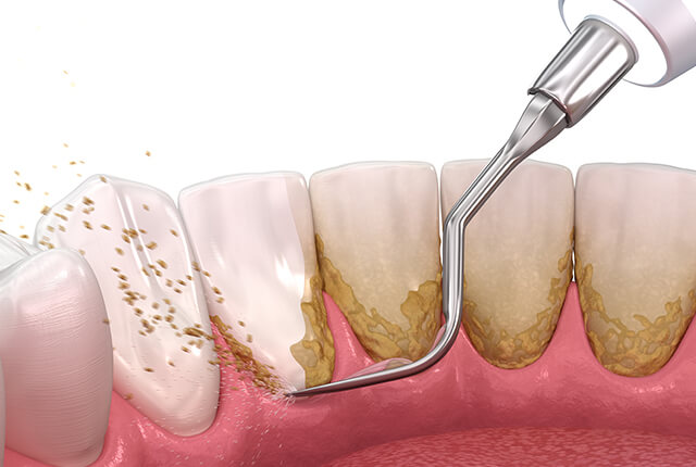 歯石のスケーリングのイメージイラスト