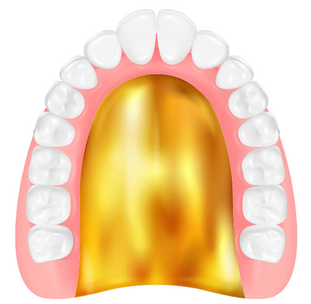 ゴールド床義歯